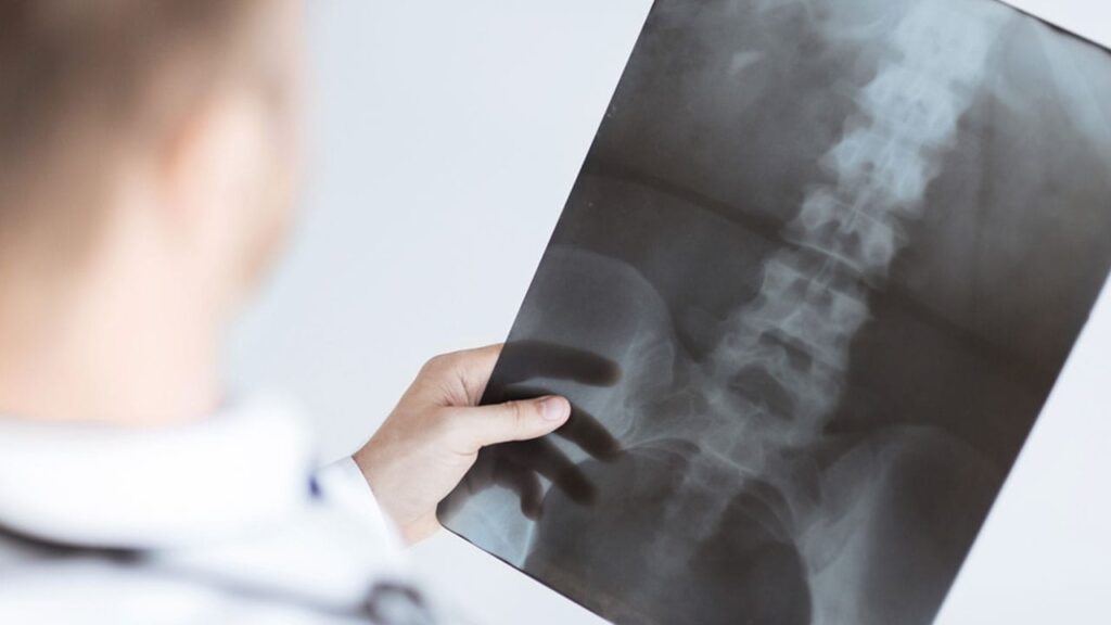 male doctor holding x-ray of Spinal injuries of a patient